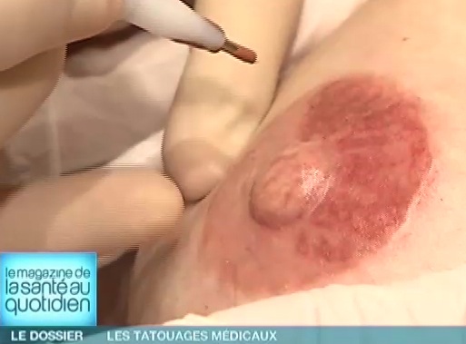 Les médias ont déjà relayé la révolution du tatouage médical