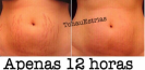 tatouage_vergetures_tattoos
